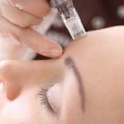 Microneedling neu bei uns in Freiburg