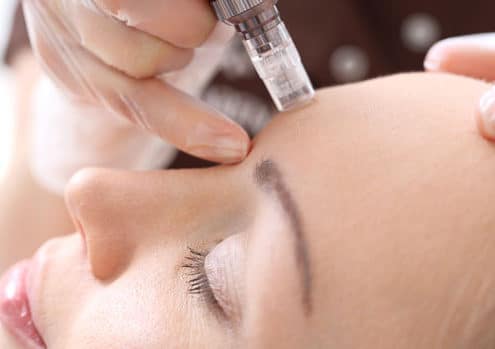 Microneedling neu bei uns in Freiburg